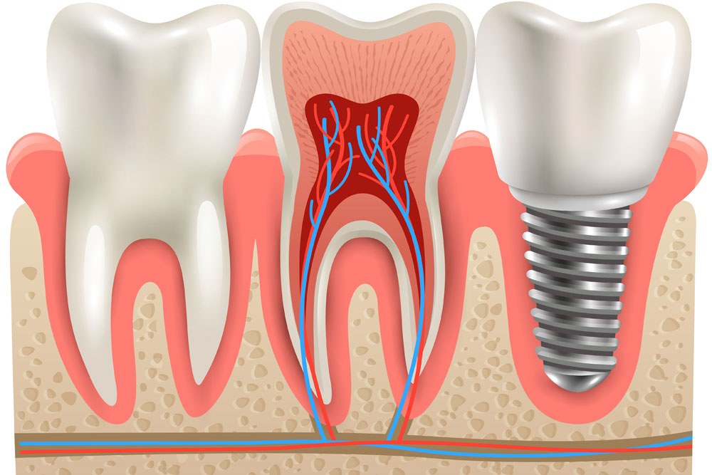 implantes - sumar salud - clínica dental Eduardo Martos
